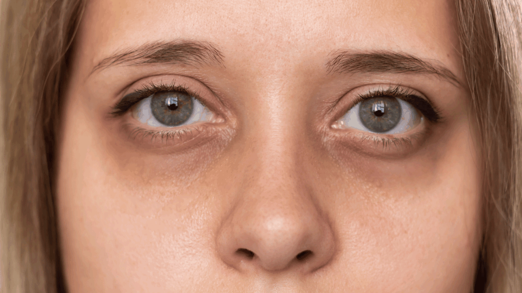 Dark Under Eye Circles & Bag | Dr Ed Robinson