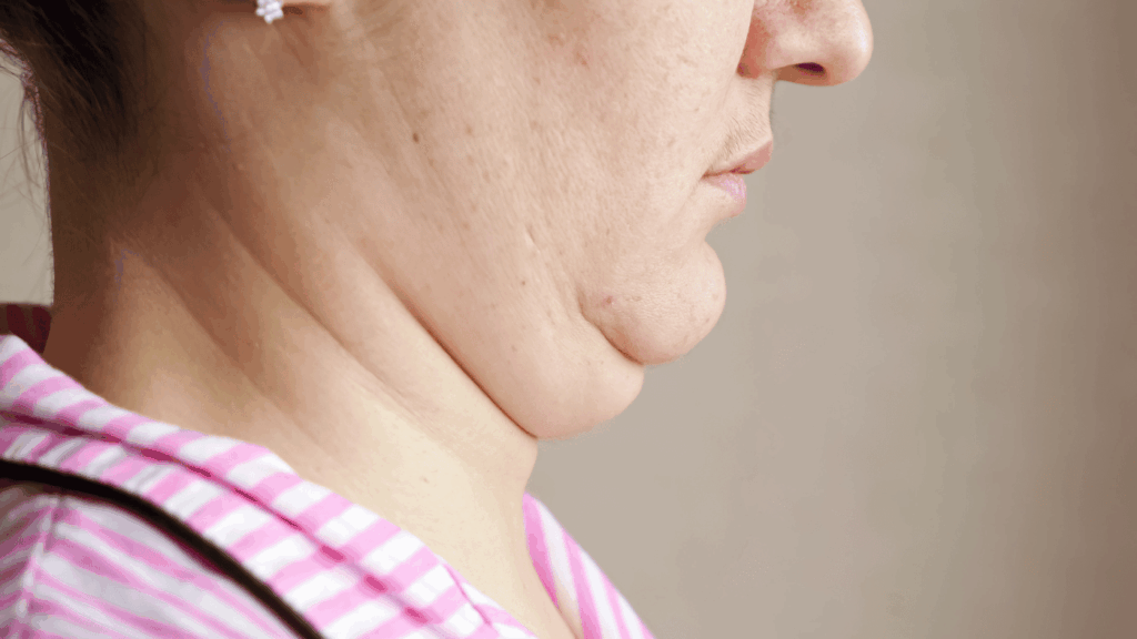 Double Chin | Dr Ed Robinson
