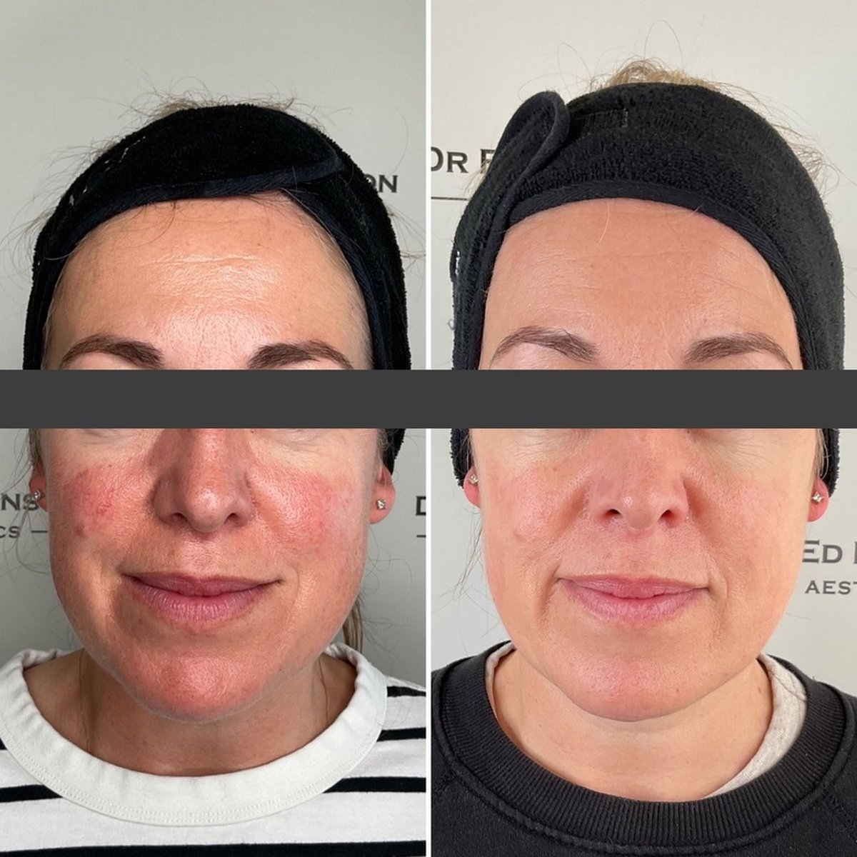 Before and after BBL treatment for rosacea at Dr Ed Robinson Clinics, Hale