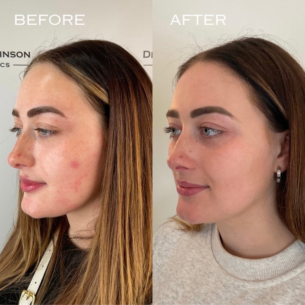 Before and after BBL and MOXI combination laser treatment at Dr Ed Robinson Clinics, Hale