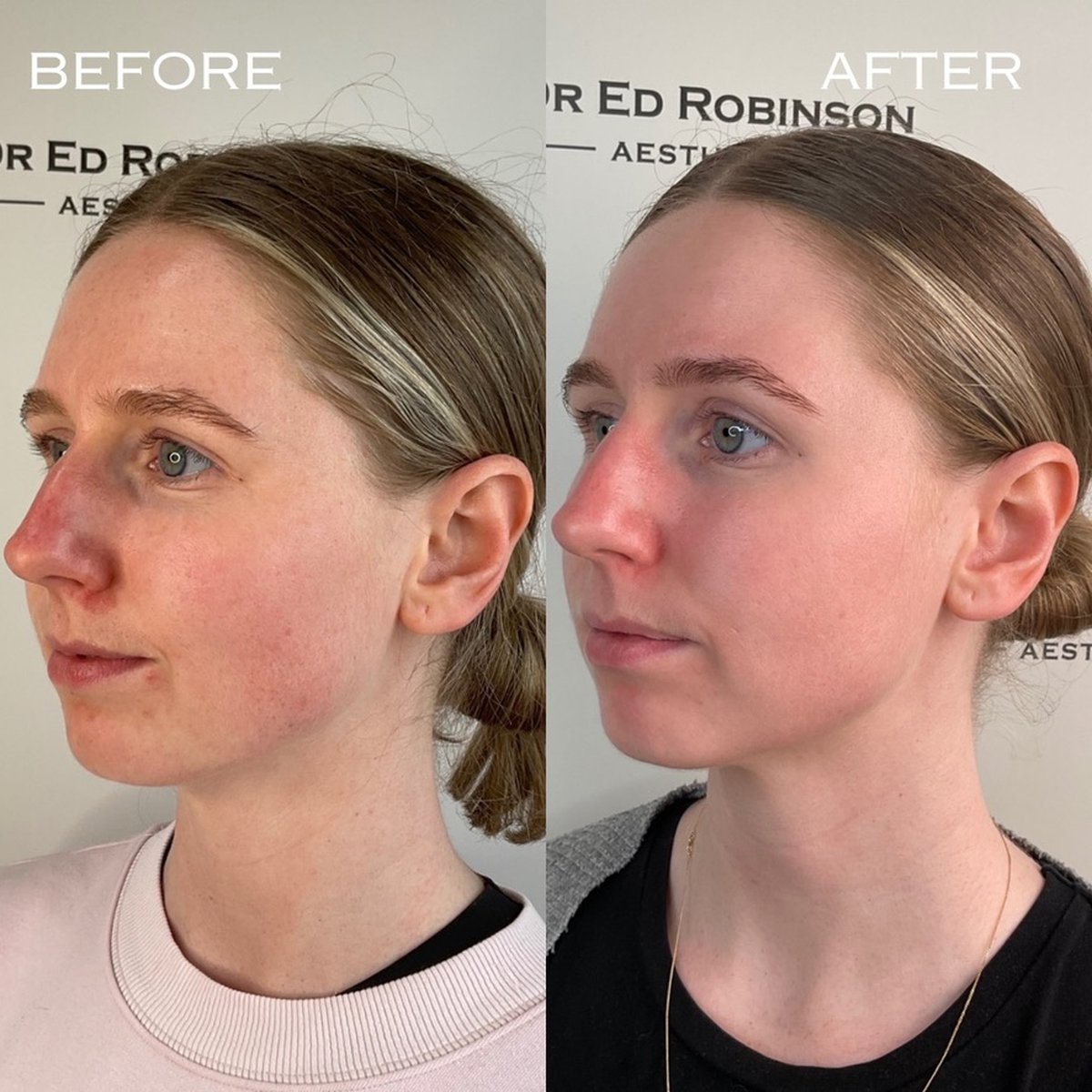 Before and after BBL and MOXI combination treatment, side view (Patient A) at Dr Ed Robinson Clinics, Hale