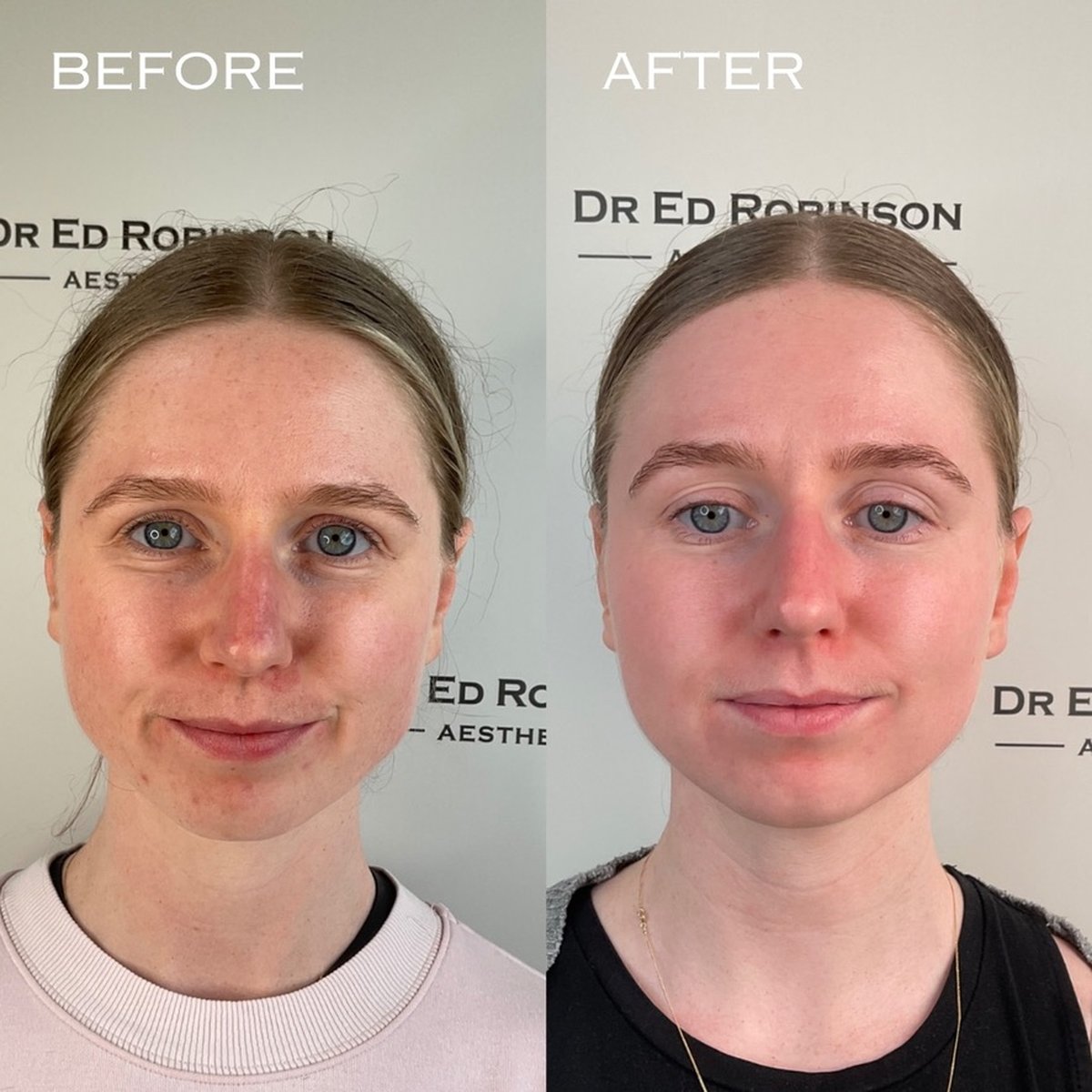 Before and after BBL and MOXI combination treatment, front view (Patient A) at Dr Ed Robinson Clinics, Hale