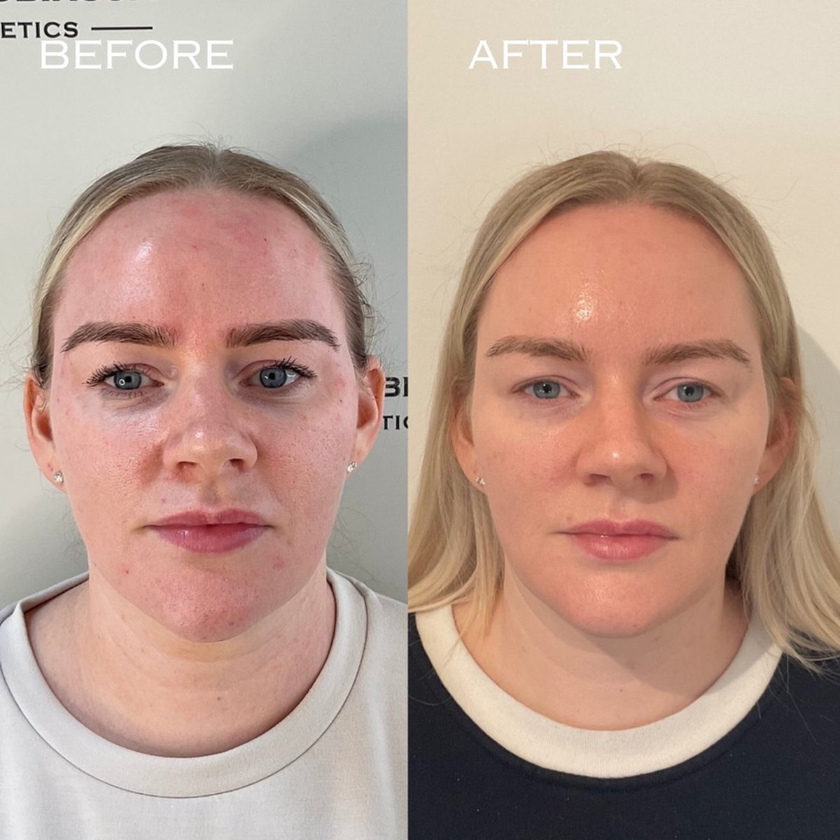 Before and after BBL and MOXI combination treatment at Dr Ed Robinson Clinics, Hale