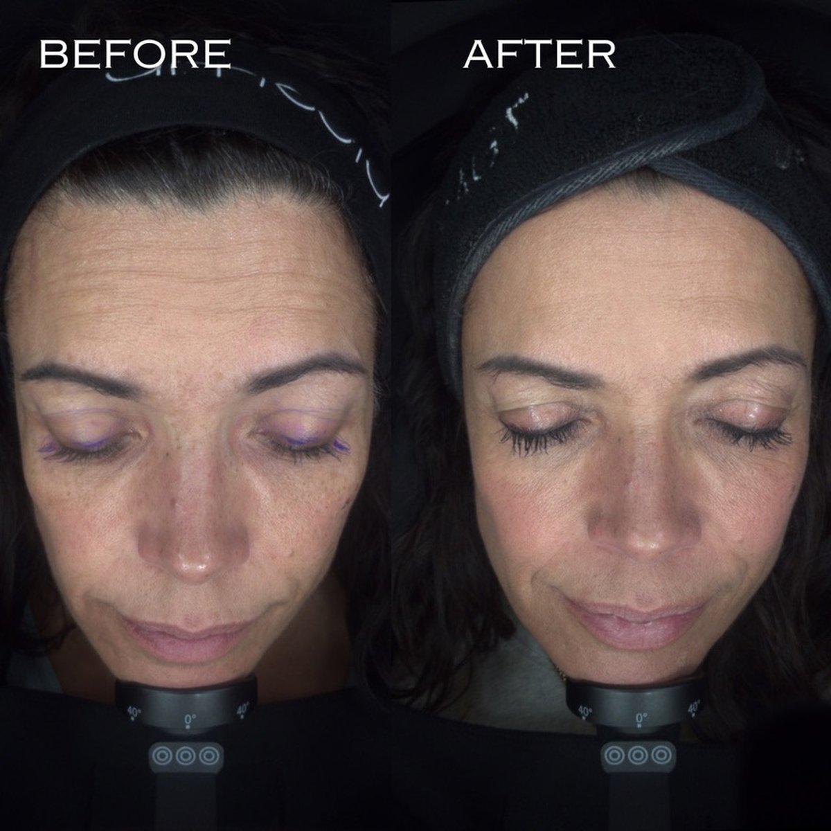 Before and after MOXI laser skin resurfacing at Dr Ed Robinson Clinics, Hale