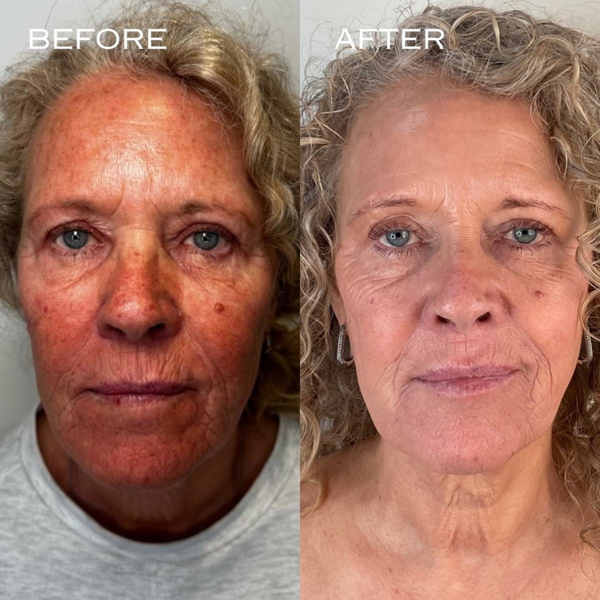 Before and after BBL, MOXI and Erbium laser resurfacing at Dr Ed Robinson Clinics, Hale