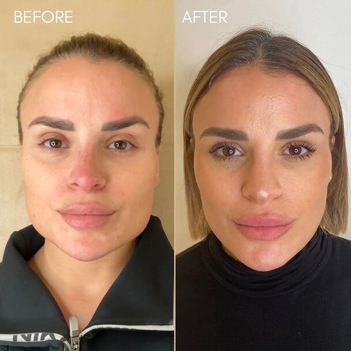 Before and after masseter jaw-slimming treatment at Dr Ed Robinson Clinics, Hale
