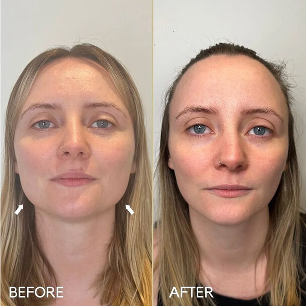 Before and after masseter jaw-slimming treatment, front view, at Dr Ed Robinson Clinics, Hale