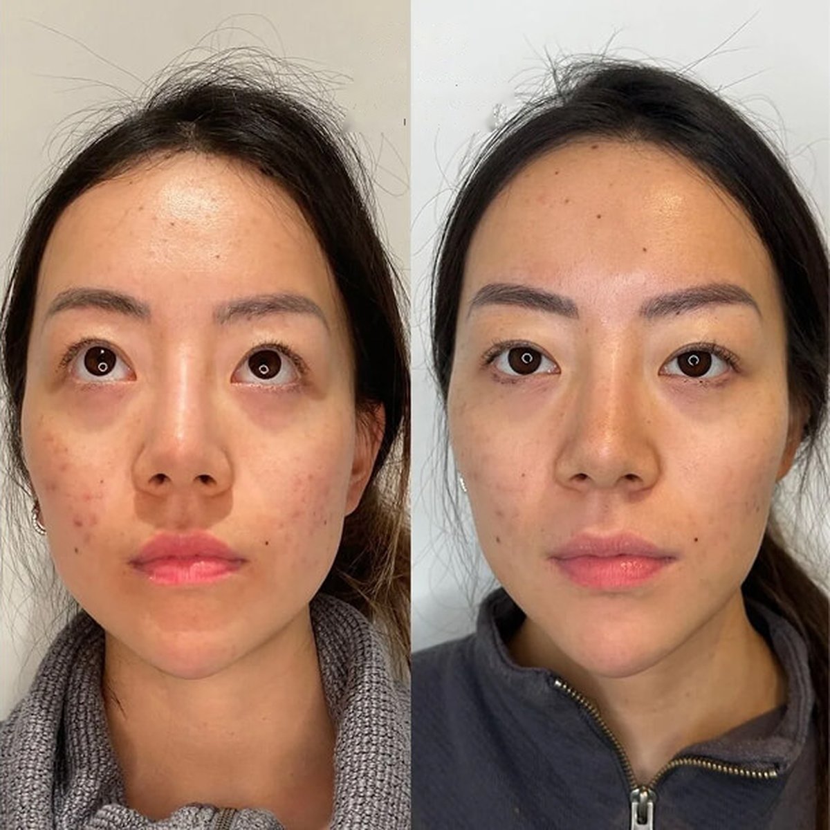 Before and after masseter jaw-slimming treatment at Dr Ed Robinson Clinics, Hale