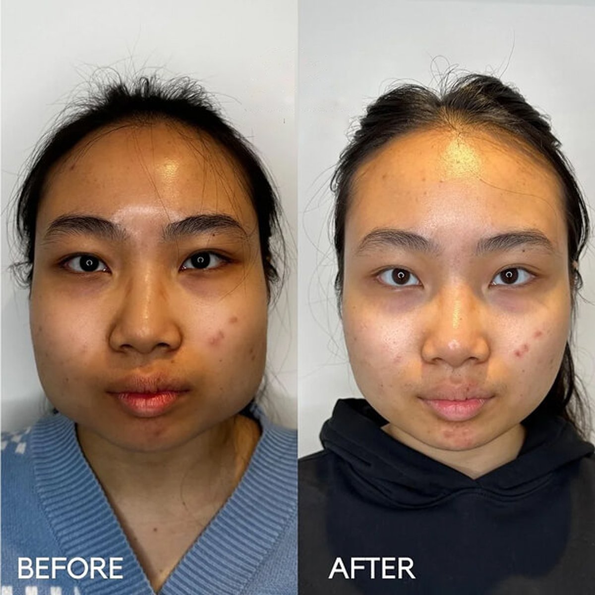 Before and after masseter jaw-slimming treatment at Dr Ed Robinson Clinics, Hale