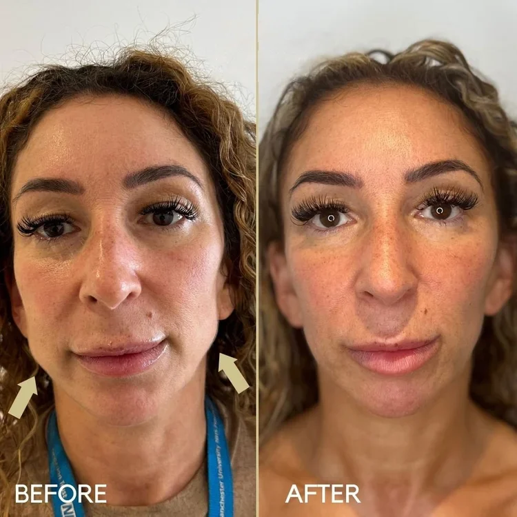 Before and after masseter anti-wrinkle injections for jawline slimming at Dr Ed Robinson Clinics, Hale