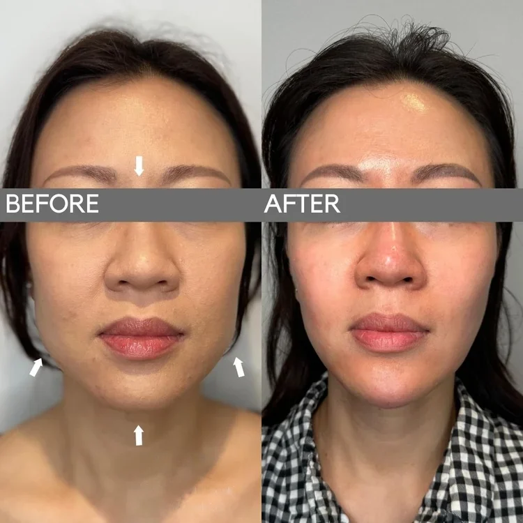 Before and after masseter injections for jawline slimming, front view, at Dr Ed Robinson Clinics, Hale